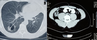 lung-cancer-pic