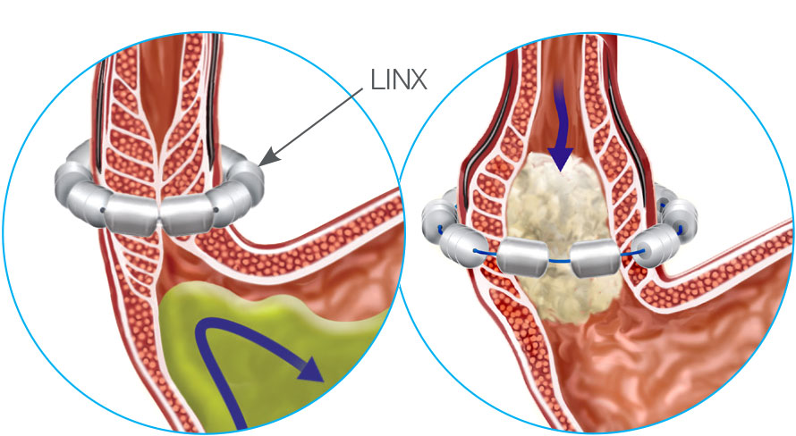 Linx - GERD