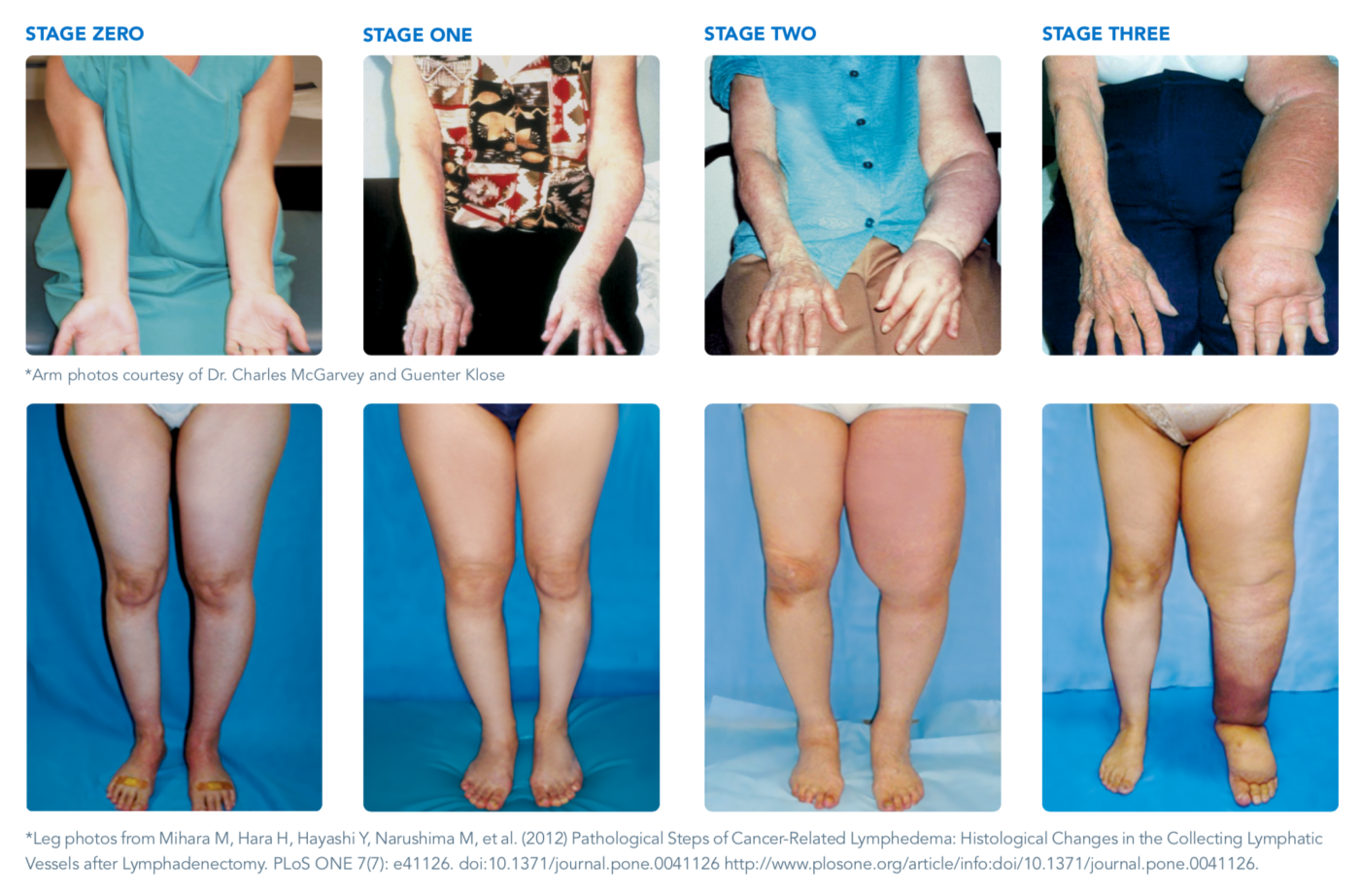 new research on lymphedema